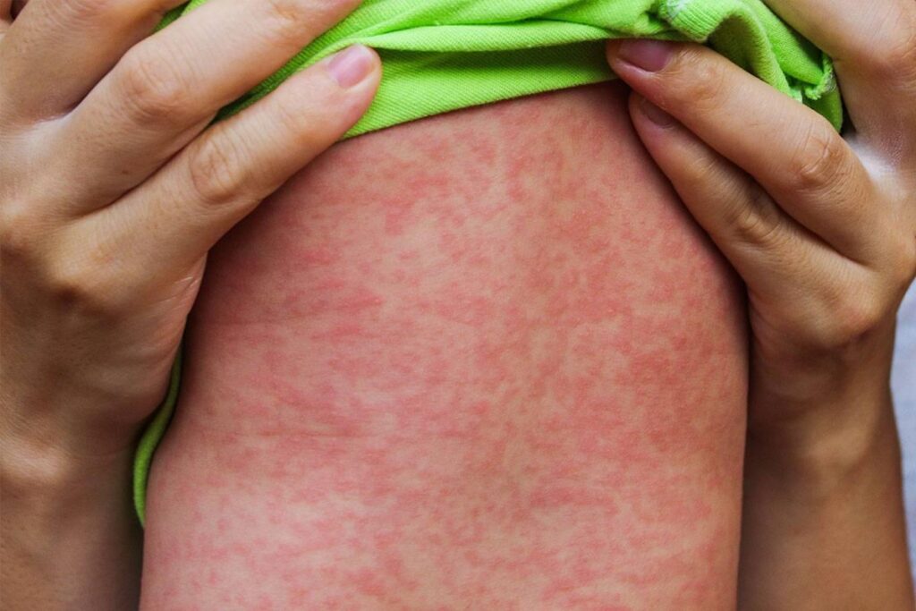 İstanbul’da Kızamık Salgını Paniği! Sağlık Müdürlüğü’nden ‘Risk Yok’ Açıklaması